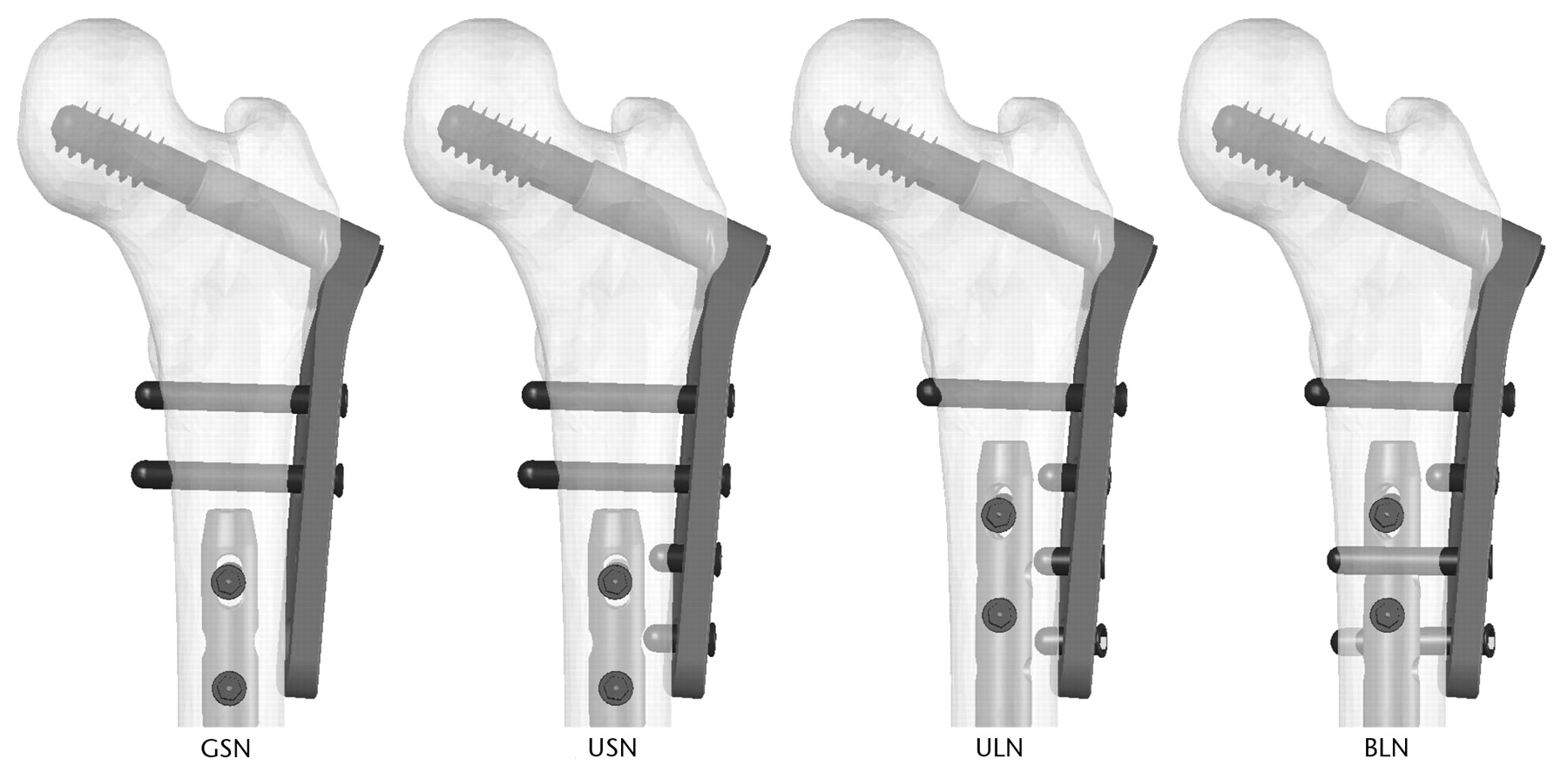 Fig. 1 
            Diagrams showing the configurations
of fixation: gapped short nail (GSN), unicortical short nail (USN),
unicortical long nail (ULN), and bicortical long nail (BLN). Only
the proximal femur is shown. GSN, USN, and BLN were tested on synthetic
femora; ULN and BLN were tested on cadaveric femora.
          
