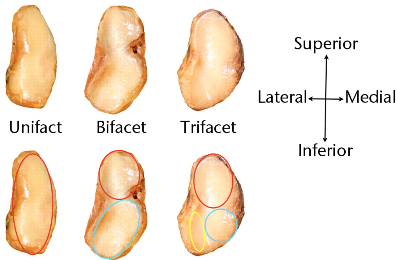Fig. 1 
            Diagram of types 1, 2 and 3 joints showing
their increasing number of facets.
          