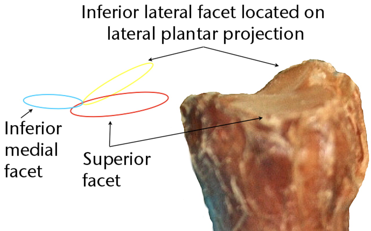 Fig. 2 
            Representation of a type 3 joint being
pictured from the dorsal surface, showing the differing projections
of the joint facets.
          