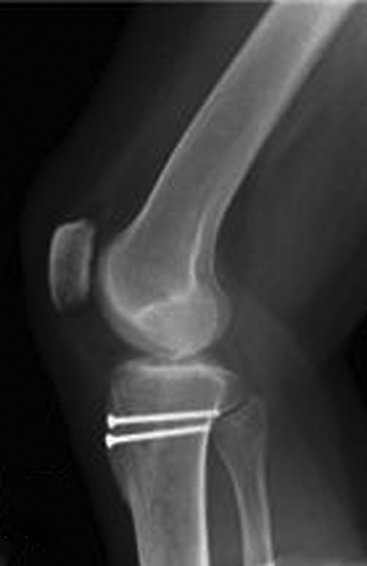 Fig. 4 
            A sample radiograph taken one year post-operatively.
          