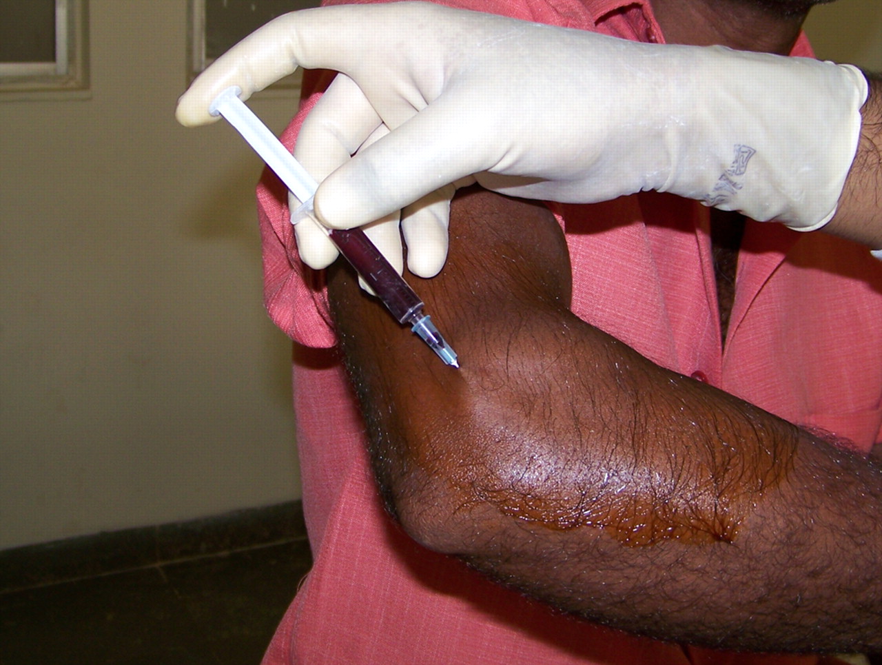 Fig. 1 
            Clinical photograph showing the injection
of autologous blood at the lateral epicondyle.
          