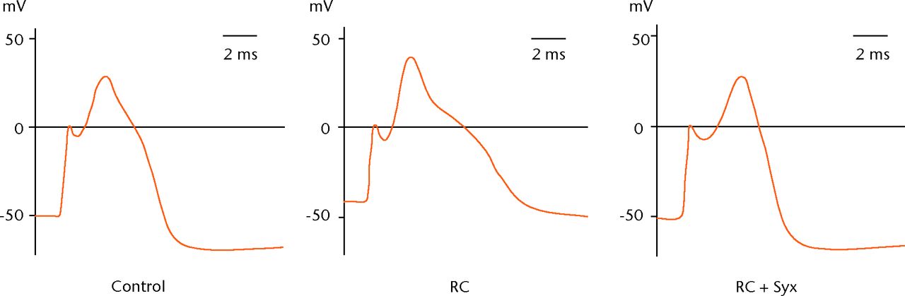 Fig. 3 
            Example graphs showing action potentials
in the short stimulation protocol. The root constriction (RC) neurons
exhibited more depolarised resting membrane potential (RMP) and
prolonged action potential duration at 50% repolarisation (APD50)
compared with the control neurons. These changes were not observed in
the RC+sympathectomy (Syx) neurons that exhibited properties similar
to controls.
          