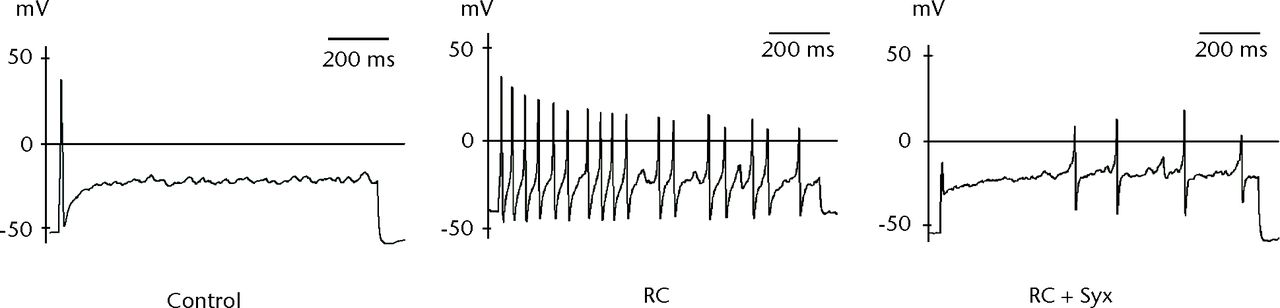 Fig. 4 
            Responses of the dorsal root ganglion
(DRG) neurons in the long stimulation protocol (maximum spike count). The
root constriction (RC) neuron exhibited an increased number of action potential
(AP) spikes and more depolarised resting membrane potential (RMP) compared
with the control neurons. These hyperexcitable alterations were reduced
in the RC+ sympathectomy (Syx) neurons.
          