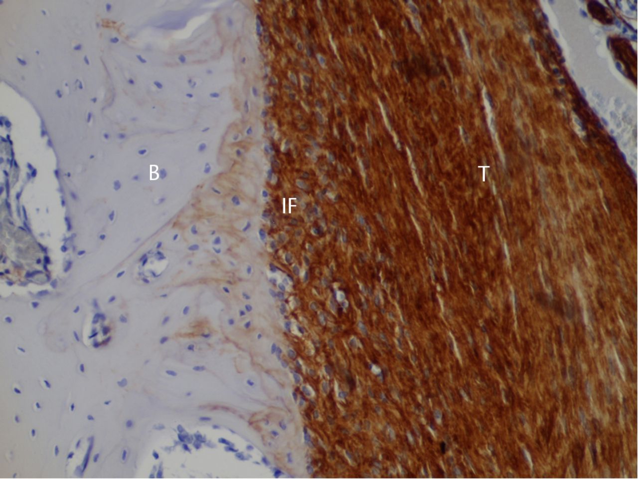 Fig. 4 
            Histological images at eight weeks post-operatively
with immunostaining for type III collagen (T, tendon graft; IF,
interface; B, bone; original magnification ×200).
          