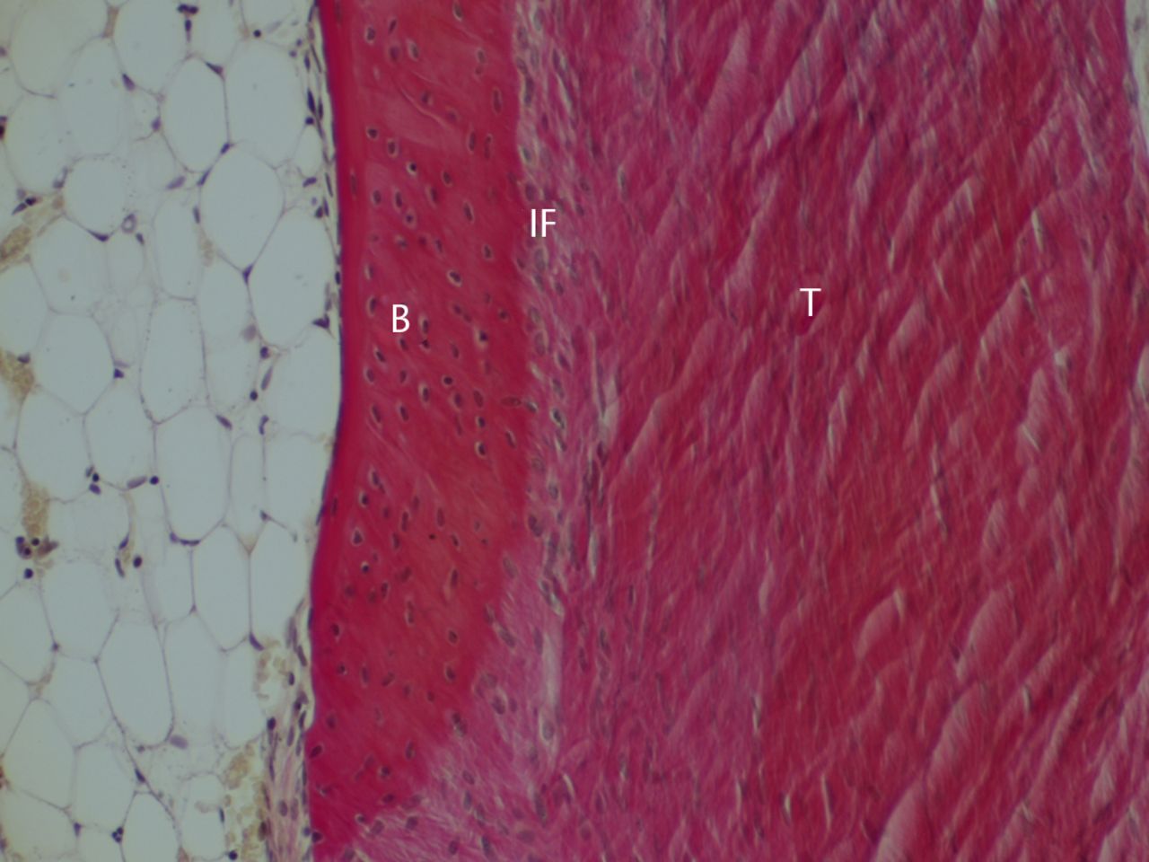 Figs. 6a - 6b 
            Histological images at 26 weeks
post-operatively with a) elastic van Gieson staining and b) immunostaining
for type I collagen (B, bone; IF, interface; T, tendon graft; all
original magnifications × 200).
          