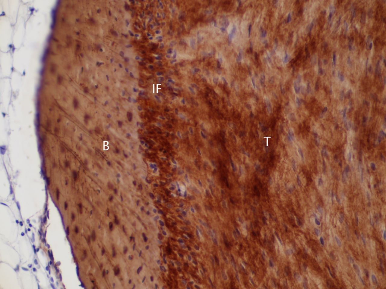 Figs. 6a - 6b 
            Histological images at 26 weeks
post-operatively with a) elastic van Gieson staining and b) immunostaining
for type I collagen (B, bone; IF, interface; T, tendon graft; all
original magnifications × 200).
          