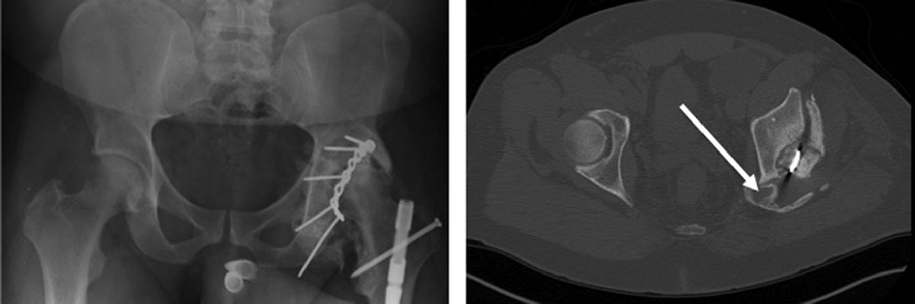 Fig. 3 
            A 37-year-old male patient sustained
a fracture of the left acetabulum and traumatic brain injury after
a high-speed automobile collision. The patient underwent open reduction
and internal fixation of the left acetabular fracture within four
days of the injury. Anteroposterior radiograph (left) and CT (right)
were taken six months after injury and show the sciatic nerve encased in
heterotopic bone (arrow). Advanced imaging was essential for diagnosis
and pre-operative planning for surgical resection.
          