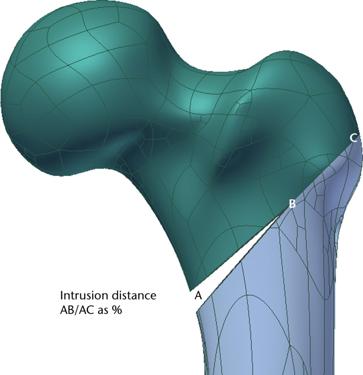 Fig. 1 
          Diagram showing the calculation
of the intrusion distance of the medial fragment into the fracture
complex: defined as the ratio of the length of the medial wedge
in the anteroposterior view (AB) to the length of the fracture line
(AC) and expressed as a percentage ([AB/AC] × 100).
        