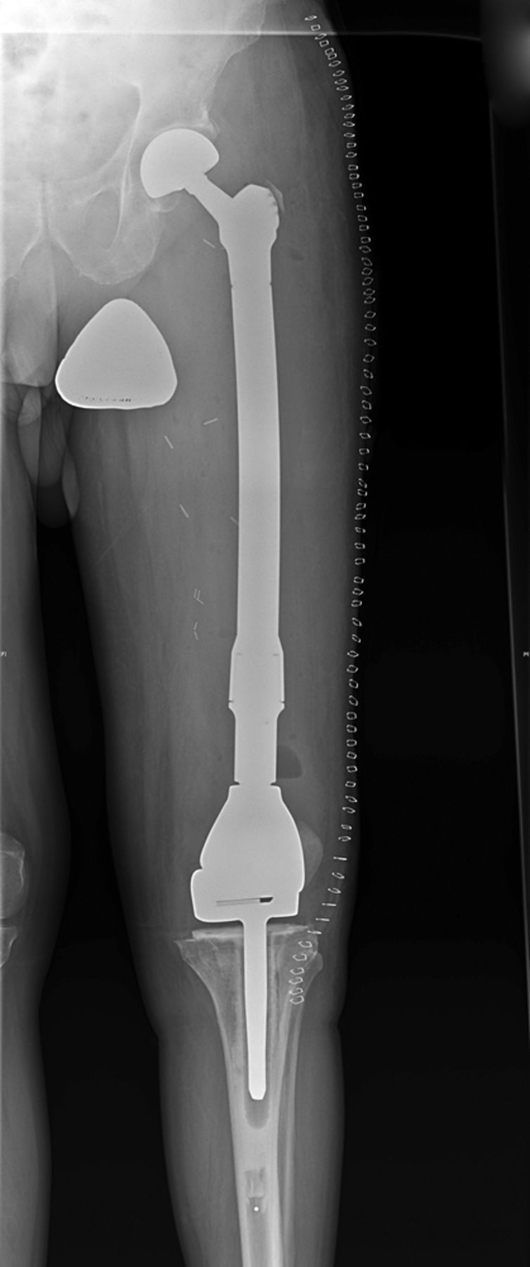 Figs. 1a - 1c 
          Case 1. Figure 1a – anteroposterior
(AP) radiograph upon presentation to the specialist orthopaedic
oncology unit, showing distal progression of the disease and impending
fracture of the implant. Figure 1b – angiogram showing selective
embolisation of the proximal metastatic deposit. Figure 1c – post-operative
AP radiograph taken three days after total femoral replacement.
        