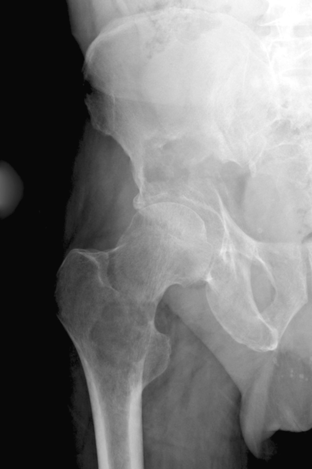 Figs. 2a - 2b 
          Case 2. Radiographs a) on presentation,
showing a pathological fracture of the right acetabulum and a lytic
lesion of the ipsilateral proximal femur, and b) at three days after
proximal femoral replacement and acetabular reconstruction using
a Graft Augmentation Prosthesis and the Harrington pin technique.
        