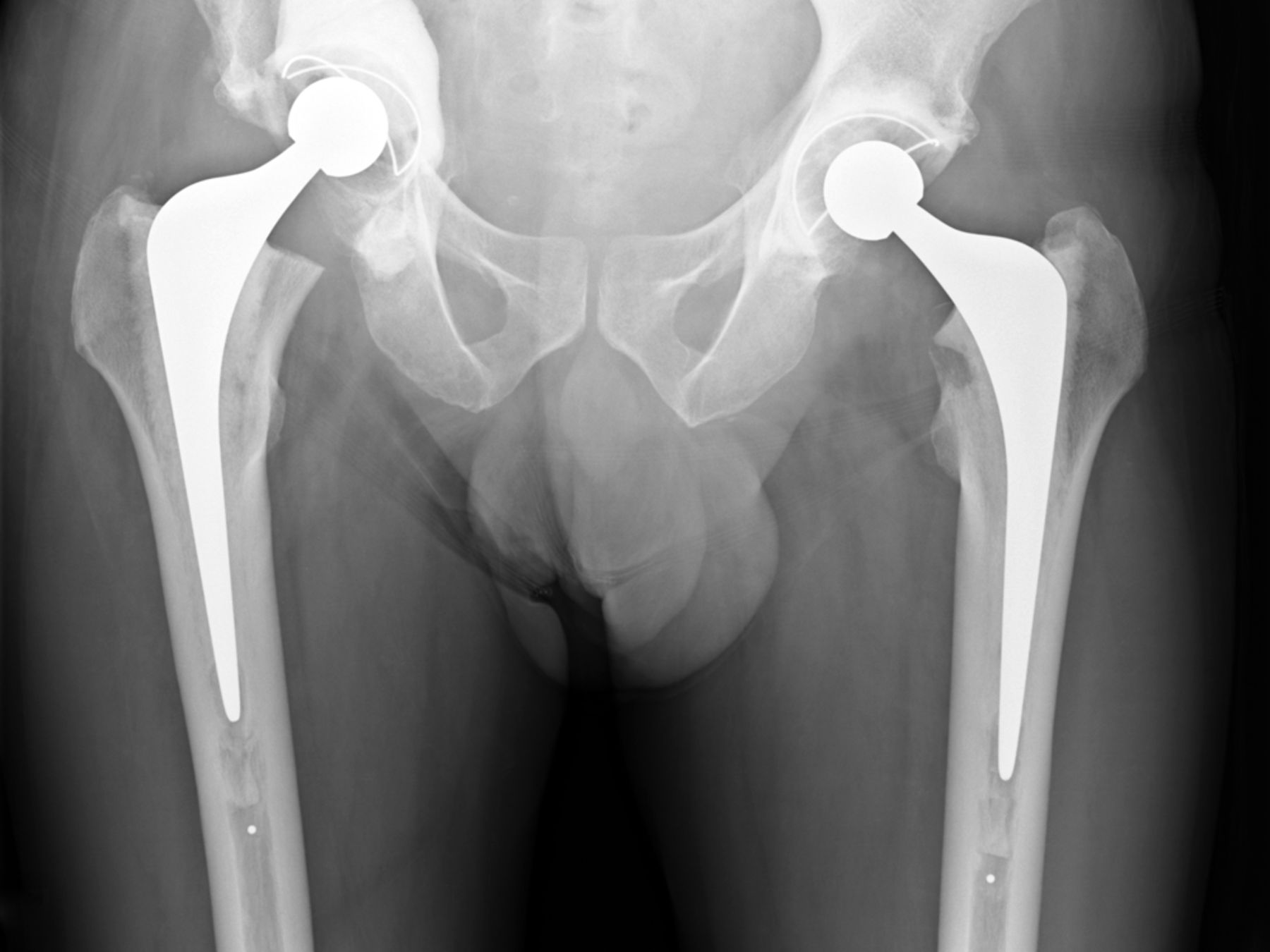 Figs. 3a - 3b 
          Case 3. Radiographs a) on presentation
to the specialist orthopaedic oncology unit, showing medial migration
of the cementoma, and b) at two days after acetabular reconstruction
using a Graft Augmentation Prosthesis, mesh and the Harrington pin technique.
        