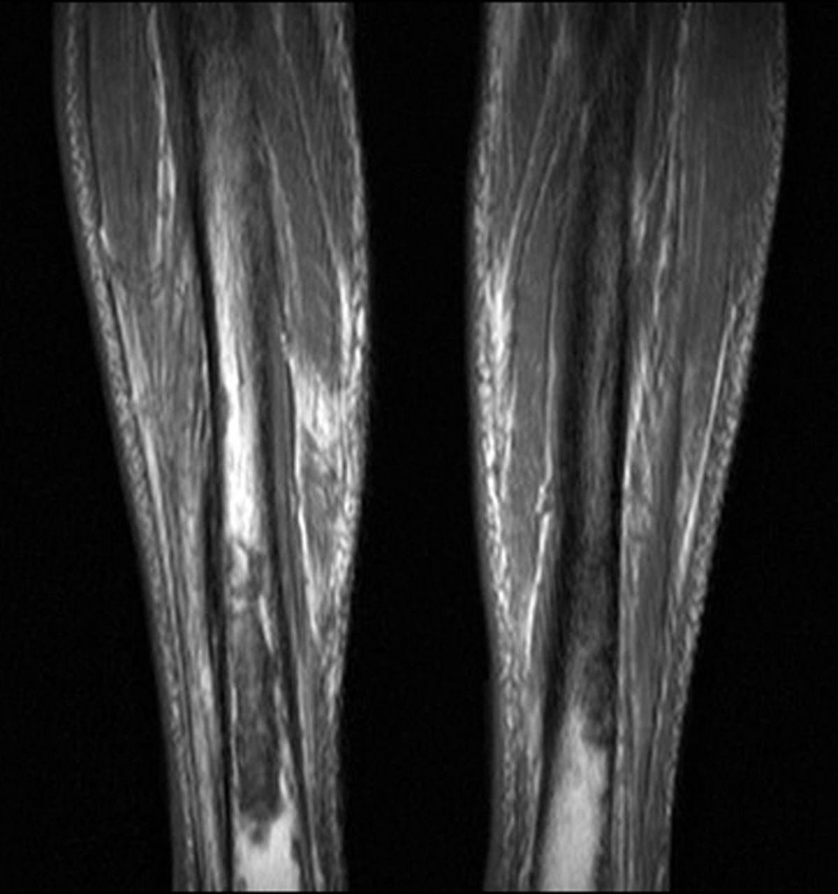 Fig. 4 
          Case 4. T1-weighted MRI showing
bilateral tibial lytic lesions with reported circumferential cortical
loss of nearly 50% in the diaphyseal axial plane.
        