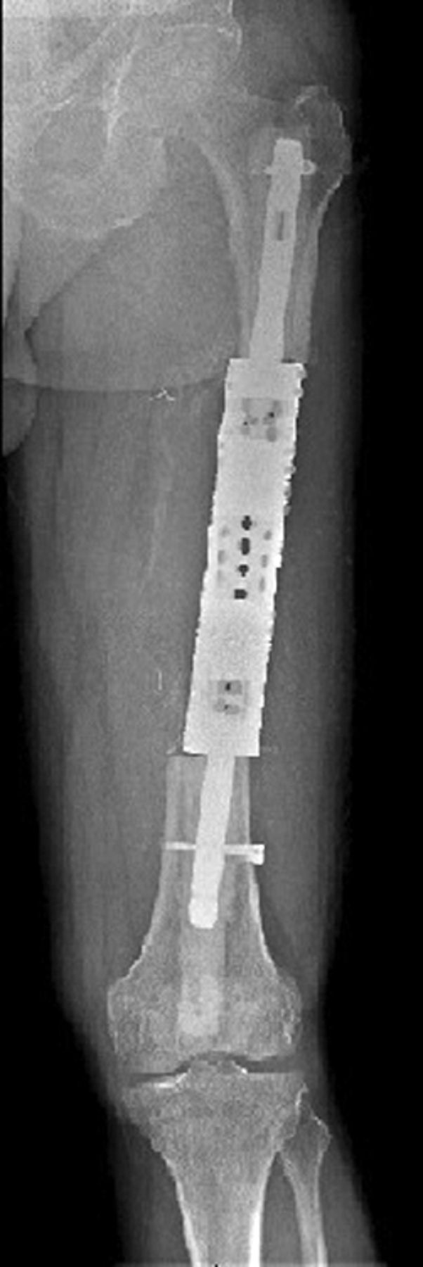 Fig. 5 
          Case 5. Anteroposterior radiograph showing
reconstruction with a proximally and distally locked segmental prosthesis
after segmental intercalary resection.
        