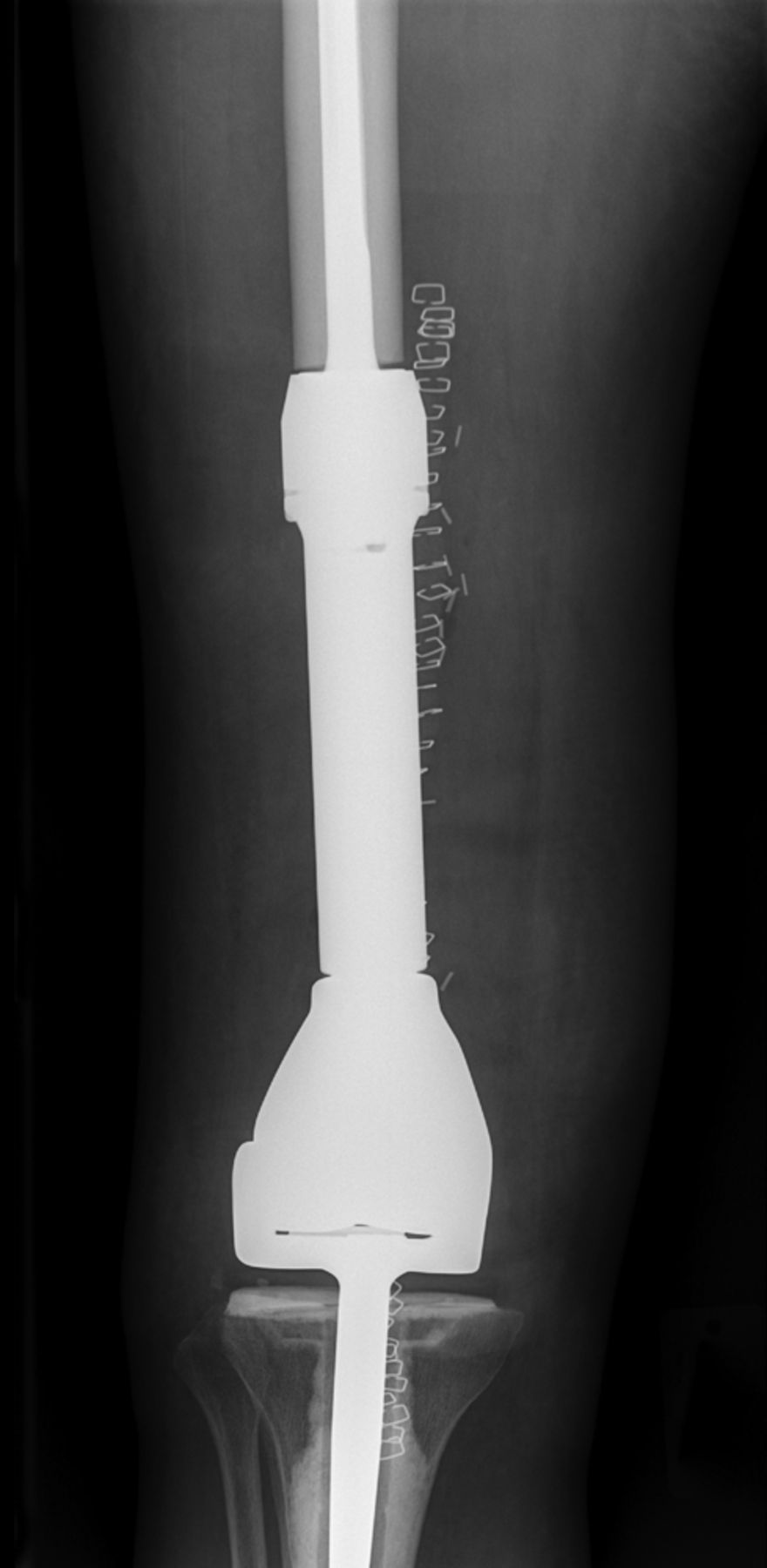 Fig. 6 
          Case 6. Anteroposterior radiograph showing
distal femoral resection and replacement using a Stanmore distal
femoral endoprosthesis (Stanmore Implants, Stanmore, United Kingdom).
        