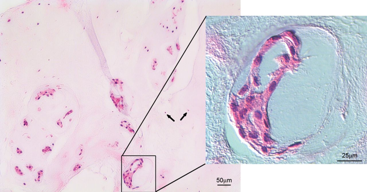 Fig. 1 
          Haematoxylin and eosin staining of bovine
nucleus pulposus tissue, showing small chondrocyte-like cells (arrows)
coexist with large vacuolated notochordal cells (magnified area).
        