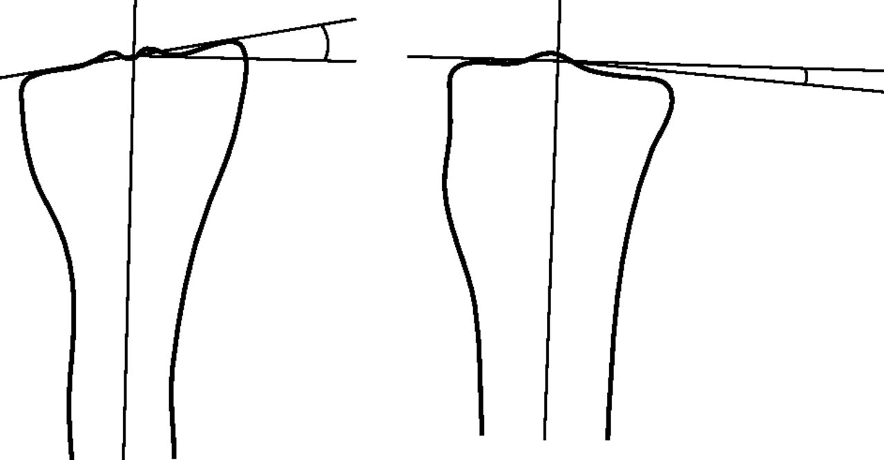 Fig. 4 
            Diagram showing how the angular deformity
is measured between the long axis of the tibia and the tibial plateau
(anteroposterior view on the left).
          