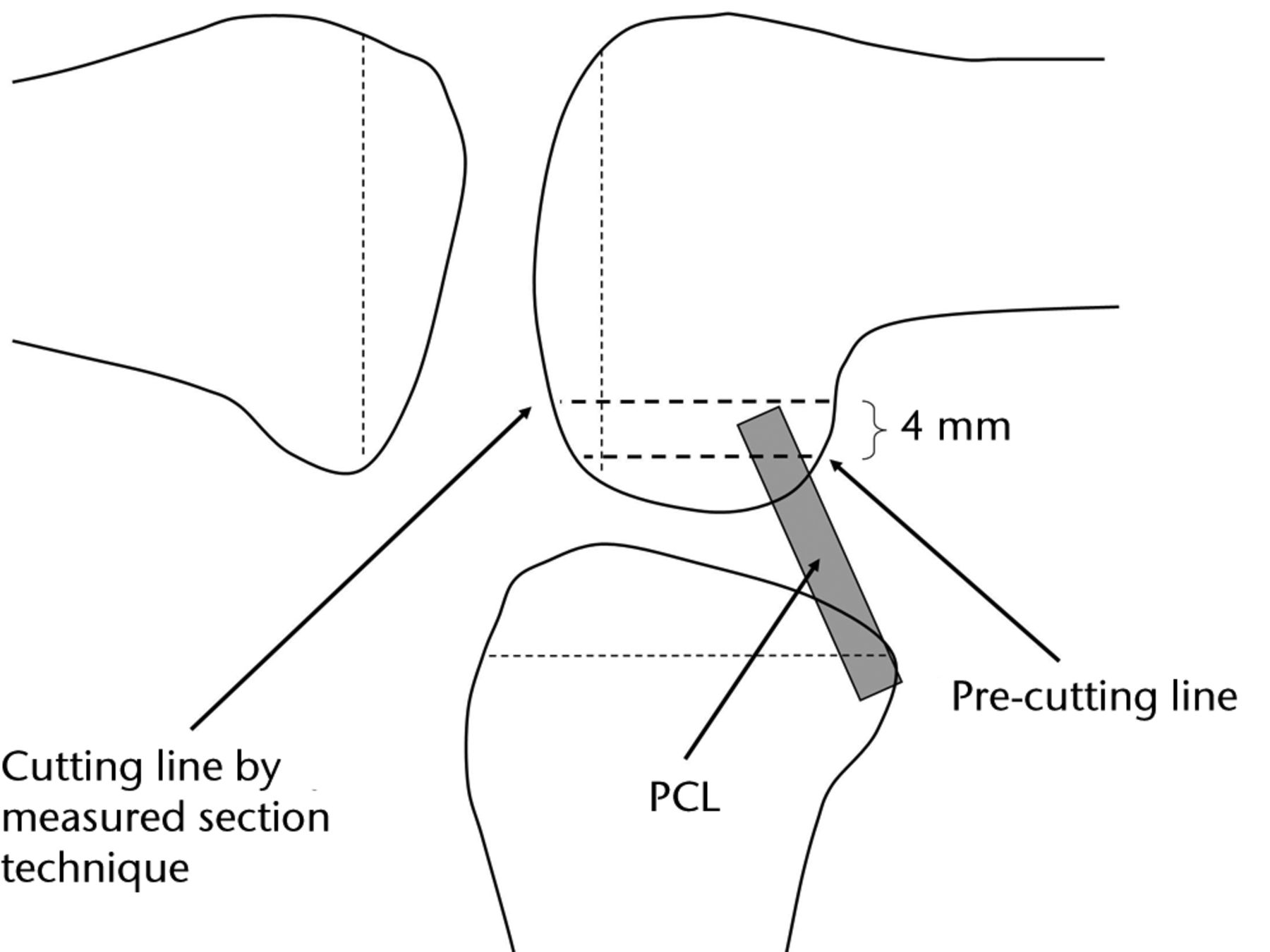 Fig. 1 
          Diagram showing the pre-cut of
the femoral posterior condyle.
        