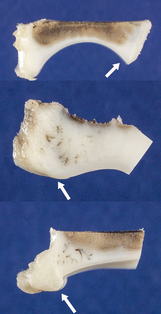 Fig. 1 
          Photographs showing acetabula from mid-coronal
plane decalcified sections. Arrows point to the lateral acetabular
region. Top: normal acetabulum from non-operated side of piglet
at 11 weeks of age. Middle: outer portion of acetabulum from operated side
at 11 weeks of age illustrates shallower arc of the articular surface,
widened and blunted outer rim of acetabulum and reactive vessel
accumulation (brown linear densities). Bottom: outer portion of
acetabulum from operated hip at 11 weeks of age illustrates diminished
arc of articular surface and asymmetric overgrowth of cartilage
instead of the normal triangular outer rim.
        