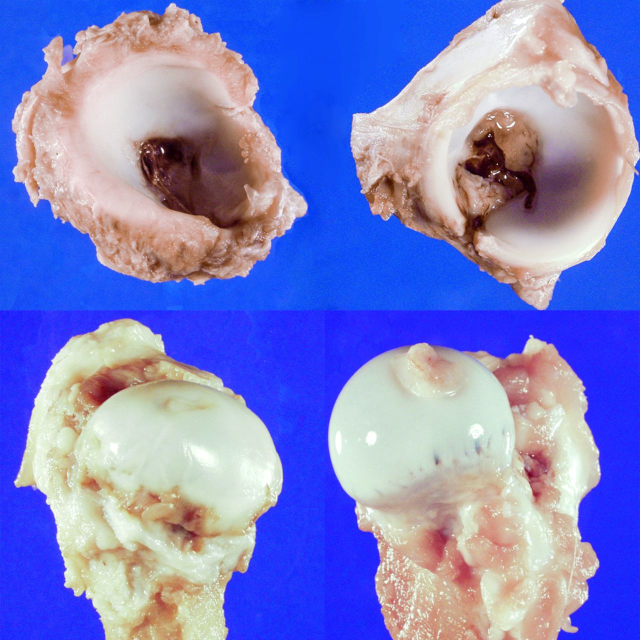 Fig. 2 
          Top: photographs show operated side
acetabulum on the left and non-operated side on the right. Note
well defined outer rim on normal side and flattened rim with wider
opening on operated side. Below, the corresponding femoral heads
are shown. The femoral head and neck with avascular necrosis (AVN)
shows flatter, wider head with shorter neck and more prominent greater trochanter.
        