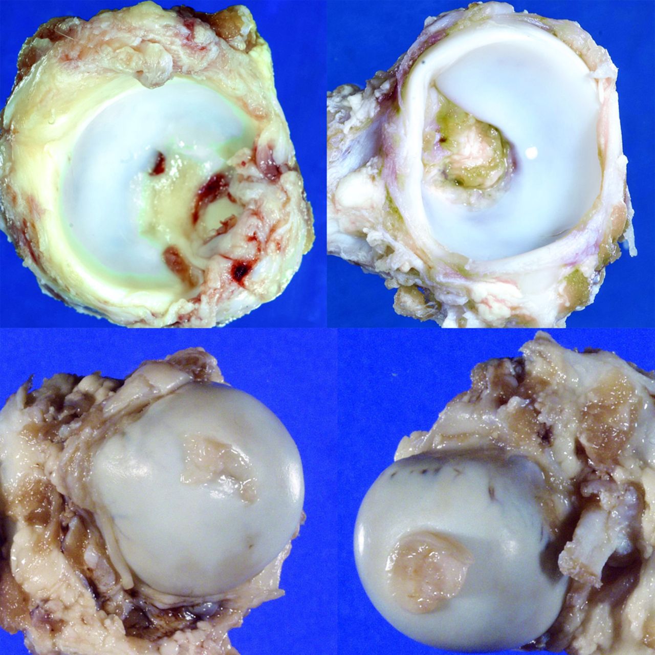 Fig. 3 
          Top. Photographs show deformed acetabulum
from operated side with flattened outer rim, shallow socket and
flattened outer cartilage surface (left). Normal non-operated acetabulum
(right) shows differences from operated side. Below, femoral heads
are seen in superior views. Asymmetric shape of operated femoral
head (left) is seen.
        