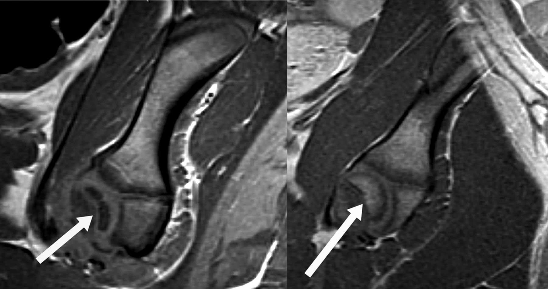 Fig. 4 
          MRI (left) from operated hip eight weeks
post-surgery shows irregularly shaped femoral head (white arrow)
and abnormal acetabulum with bony under-development anteriorly.
Tri-radiate cartilage is abnormal and widened in parts. The ilium
is shown above with iliac crest apophysis. MRI (right) from the
normal hip shows the sphericity of the femoral head (white arrow)
and adjacent acetabulum. Tri-radiate cartilage and ilium are normal.
        