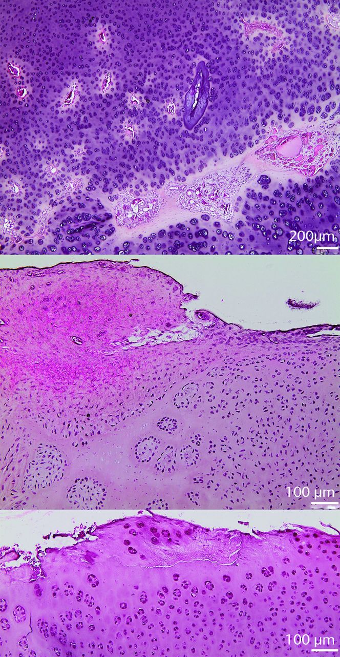 Fig. 7 
          Histologic sections from the lateral
region of the acetabular articular cartilage showing (top figure)
multiple abnormal intracartilaginous vessels and fibrovascular invasion
(lower right); (middle figure) peripheral fibrocartilaginous reactive tissue,
with pannus fibrovascular overgrowth and circular cartilaginous
clones in otherwise hypocellular area; and (lower figure) hypocellular
cartilage surface with fibrillation and transverse cleft.
        
