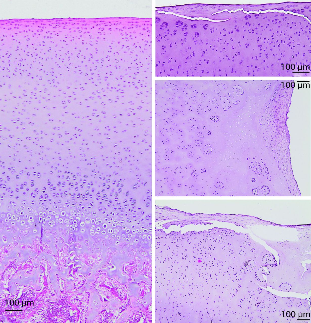 Fig. 8 
          Histology sections show normal sequence
from the articular surface to the bone of the ilium (left side).
On the right, abnormal articular cartilage from the operated-side
acetabula shows surface abnormalities with acellular regions, superficial transverse
tears (top); pannus, acellular cartilage with empty chondrocyte
lacunae, chondrocyte clones (middle) and superficial transverse
fissures through acellular cartilage clone region (lower).
        