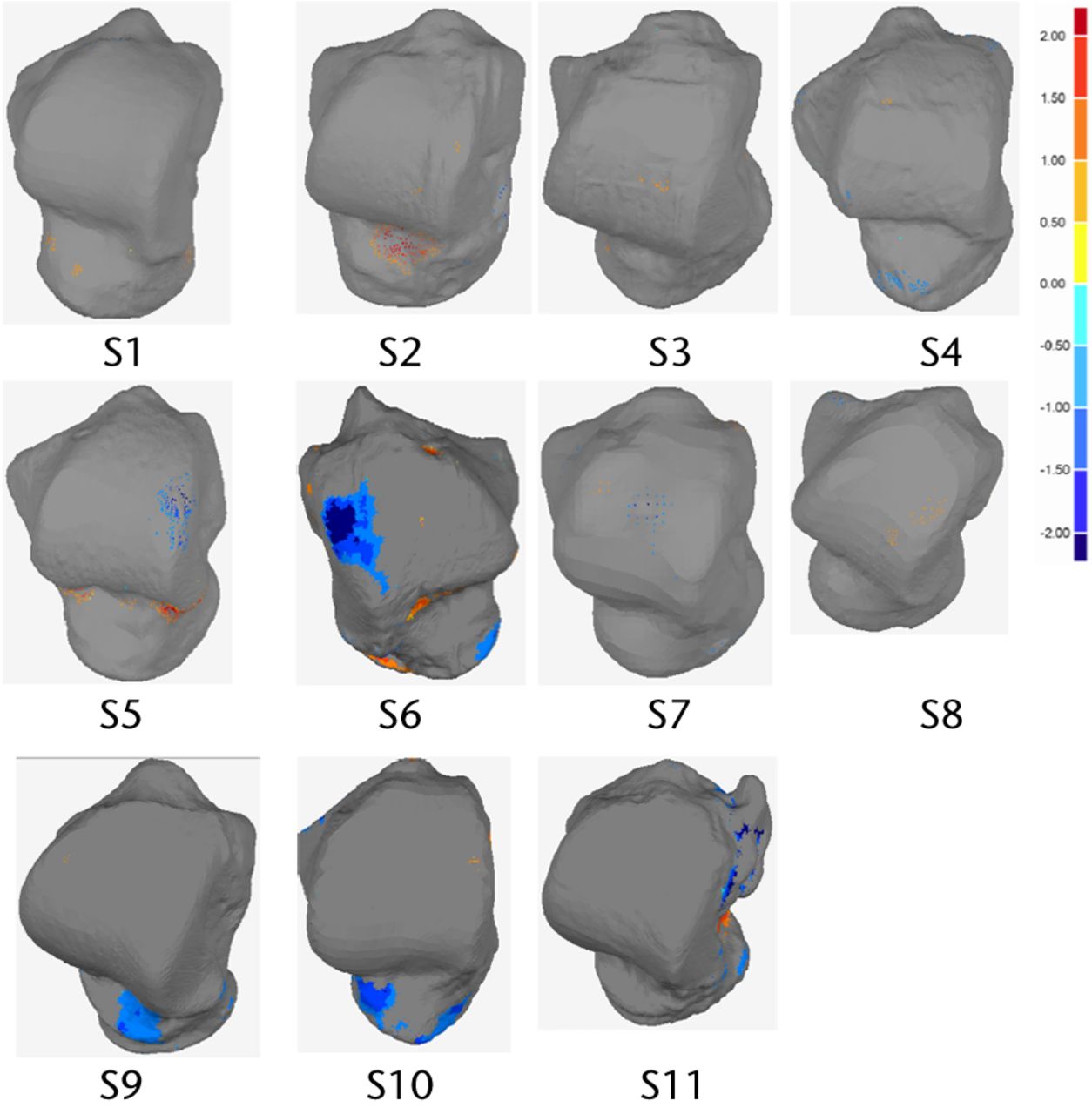 Fig. 4 
          Dorsal view of analysed talus models
and deviation colour maps (DCM) (mm) showing the regions with deviation
higher than 1mm.
        