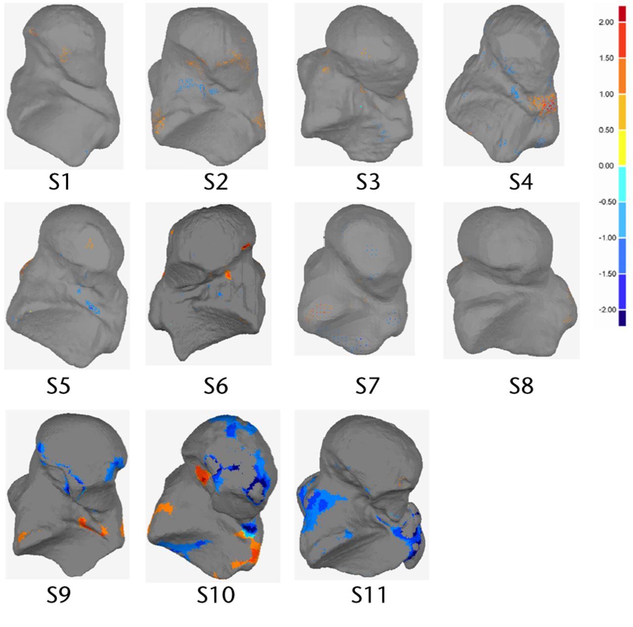 Fig. 5 
          Plantar view of analysed talus models
and deviation colour maps (DCM) (mm) showing the regions with deviation
higher than 1mm
        