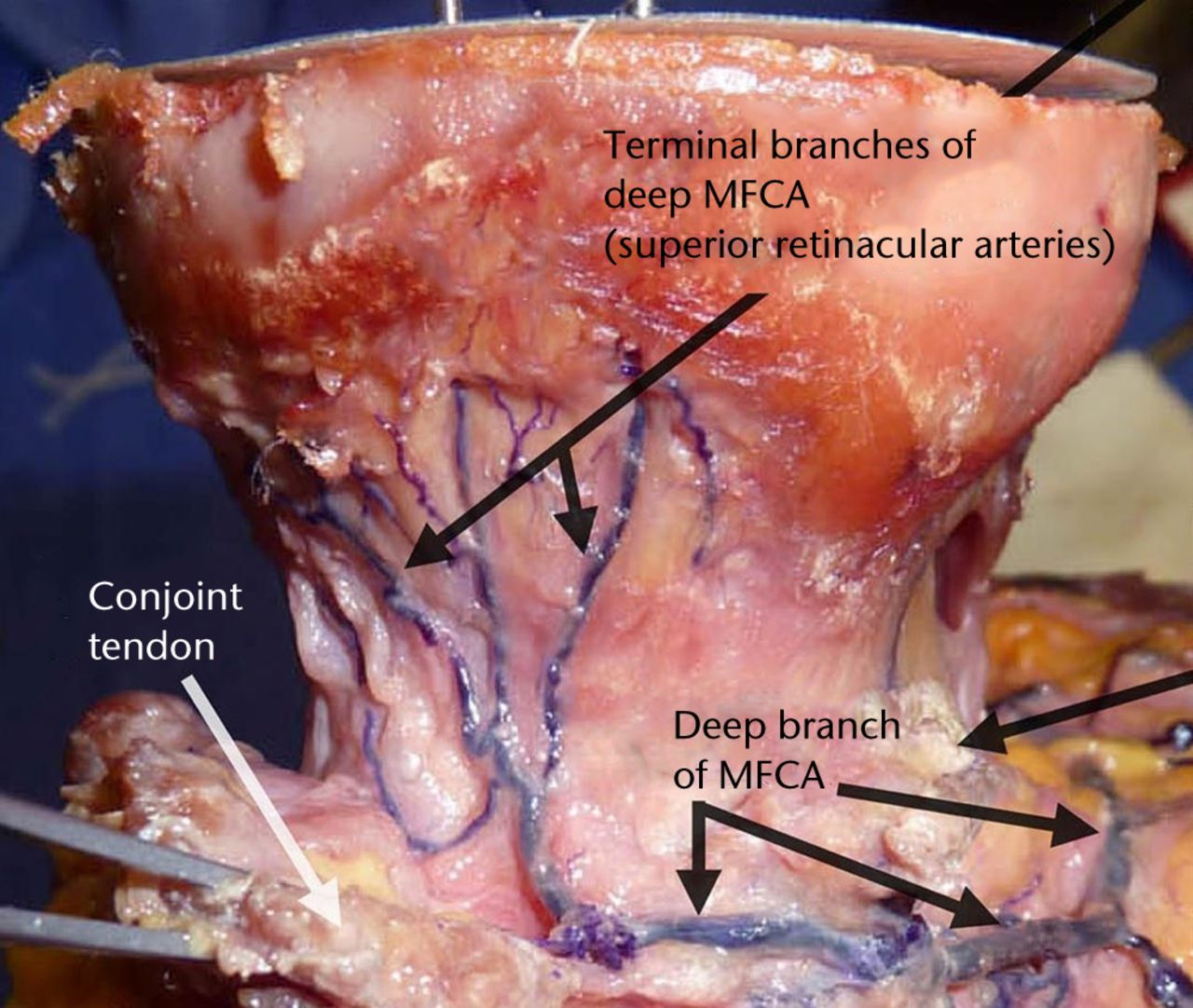 Fig. 1 
          Photograph showing a femoral head. The
main blood supply comes from the deep branch of the medial femoral circumflex
artery (MFCA).
        