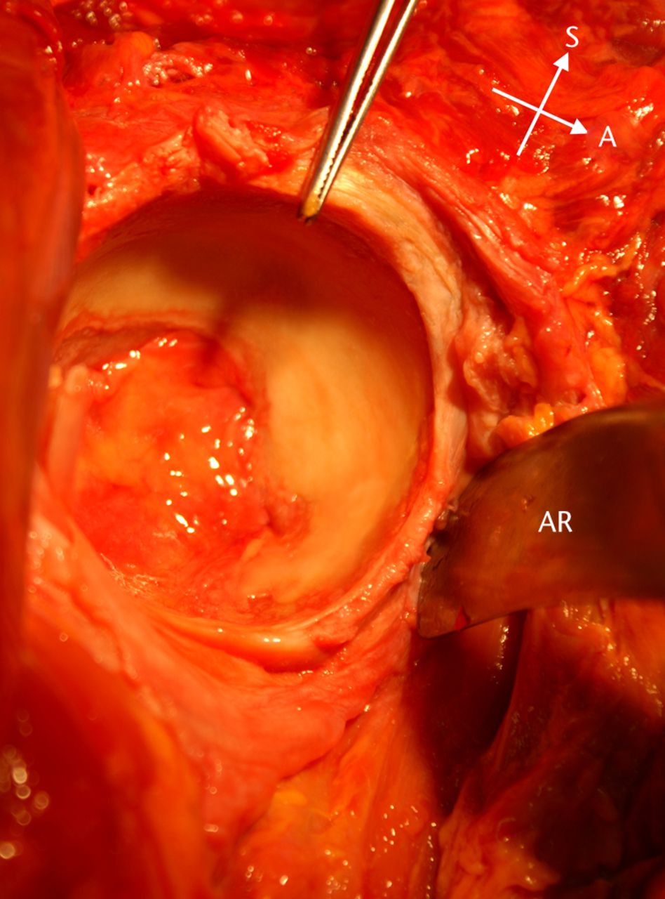 Fig. 1 
          Photograph showing the anterior
retractor (AR) in situ around the anterior wall
of the acetabulum. Forceps indicate 12 o'clock position on acetabulum.
        
