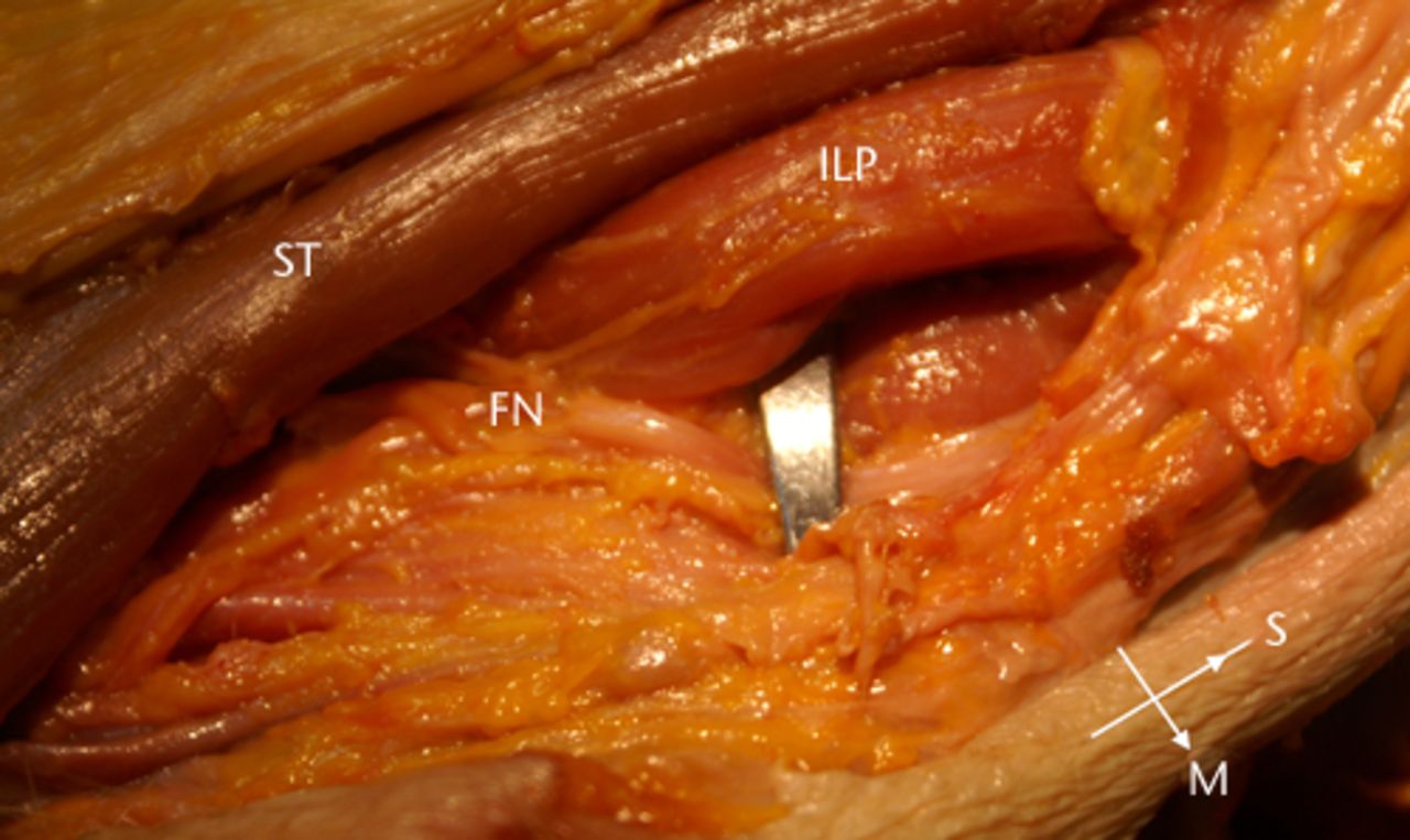 Fig. 3 
            Photograph of the anterior retractor
compressing the femoral nerve (FN) as it passes through the femoral
triangle, overlying the iliopsoas (ILP); ST, Sartorius.
          