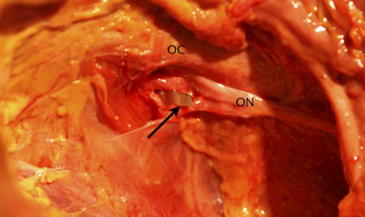 Fig. 4 
            Photograph showing the inferior retractor
piercing the obturator membrane, lateral to the obturator nerve
(ON) as it passes through the obturator canal (OC).
          