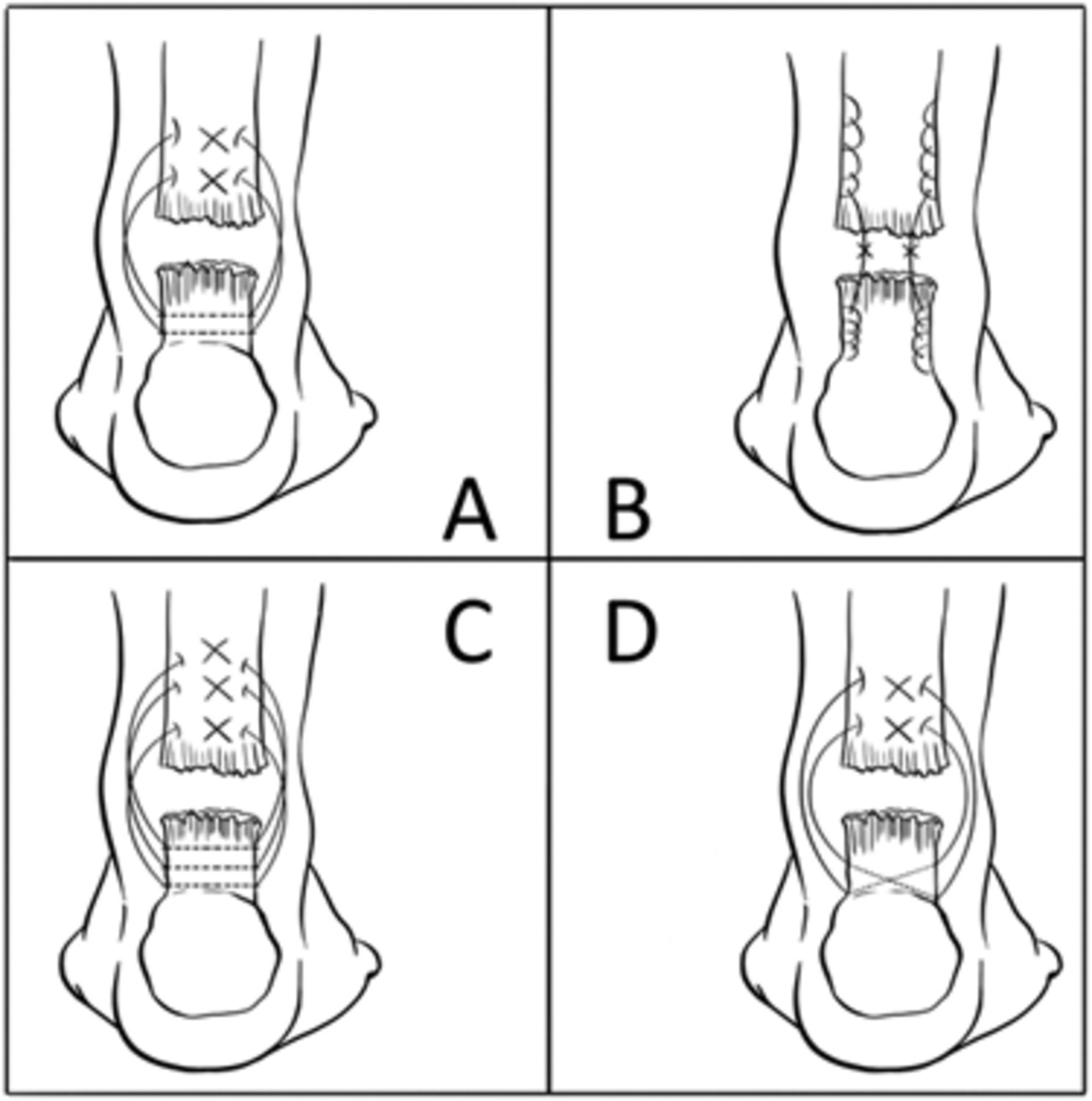 Fig. 3 
          Diagram showing the suture configurations
of the a) Dresden, b) Krackow, c) triple and d) oblique technique
(figure modified from original with permission).81
        