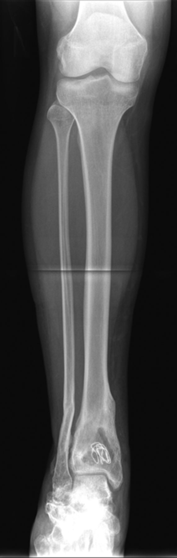 Figs. 5a - 5d 
            Radiographs showing HERAFILL®
beads G (Heraeus Medical GmbH) after implantation into a distal
tibial bone void a) pre-operatively, b) post-operatively, c) three
and d) six months post-operatively.
          
