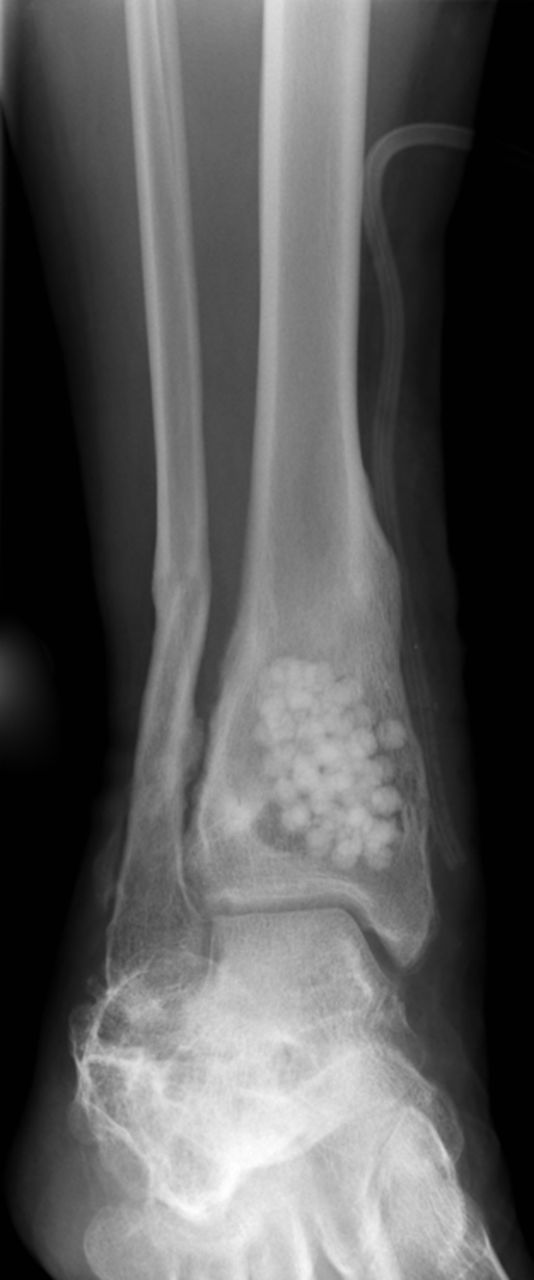 Figs. 5a - 5d 
            Radiographs showing HERAFILL®
beads G (Heraeus Medical GmbH) after implantation into a distal
tibial bone void a) pre-operatively, b) post-operatively, c) three
and d) six months post-operatively.
          
