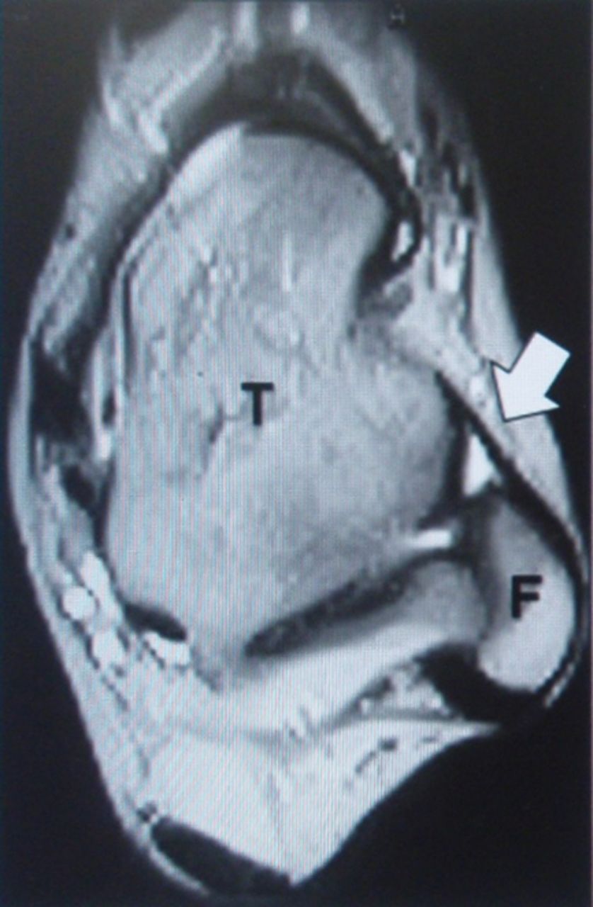 Figs. 1a - 1c 
            Axial T2-weighted images showing
typical ATFL findings (white arrows). T and F denote tibia and fibula,
respectively, the MRI evaluation was undertaken pre-operatively,
and maximum diameters of the anterior talofibular ligaments (ATFLs)
were measured.
          