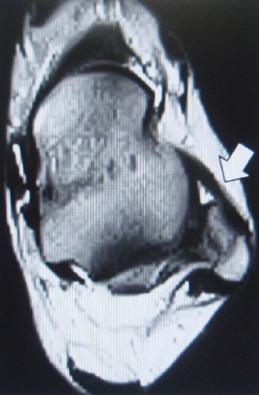 Figs. 1a - 1c 
            Axial T2-weighted images showing
typical ATFL findings (white arrows). T and F denote tibia and fibula,
respectively, the MRI evaluation was undertaken pre-operatively,
and maximum diameters of the anterior talofibular ligaments (ATFLs)
were measured.
          