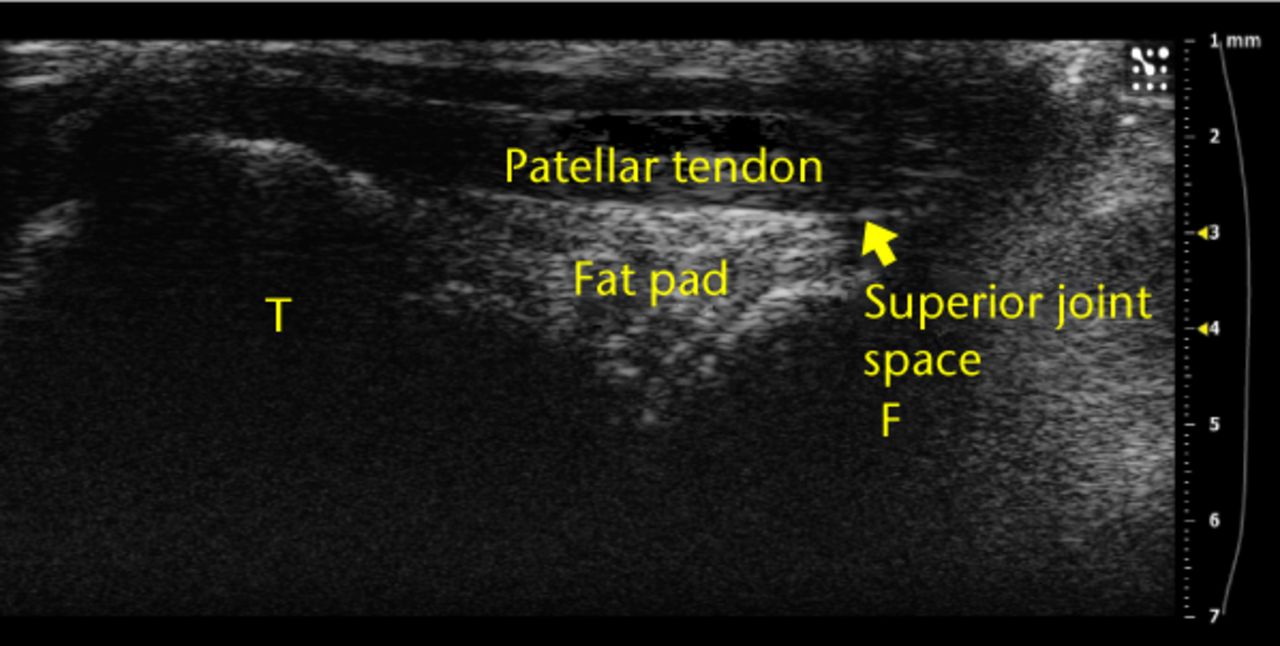 Fig. 2 
          Example ultrasound image of a knee joint
with labels over the femur (‘F’), tibia (‘T’), superior joint space and
fat pad. These anatomical landmarks were observed for each injection.
        