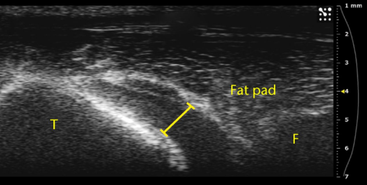 Figs. 3a - 3b 
          Ultrasound images showing substantial
separation of the fat pad from the tibia a) before and b) after
an injection.
        