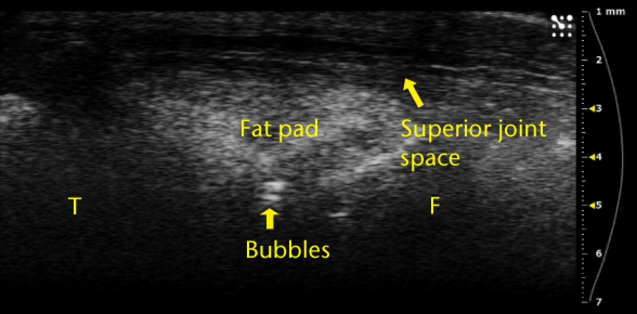 Figs. 4a - 4b 
          Ultrasound images showing a) that
bubbles helped visualise the injections and were clearly observed
in the joint space between femur and fat pad. The needle b) and
subsequent metal shadow are clearly seen during an injection that
created subcutaneous expansion.
        