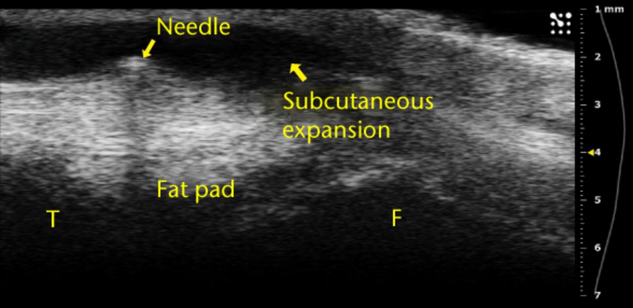 Figs. 4a - 4b 
          Ultrasound images showing a) that
bubbles helped visualise the injections and were clearly observed
in the joint space between femur and fat pad. The needle b) and
subsequent metal shadow are clearly seen during an injection that
created subcutaneous expansion.
        