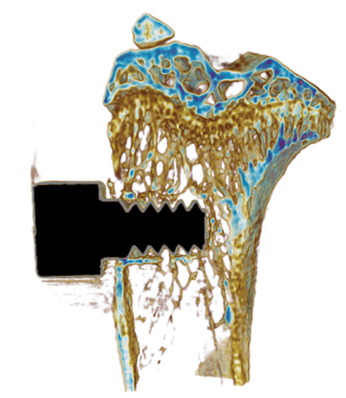 Fig. 1 
            MicroCT scan of a screw newly
inserted in the tibial metaphysis.
          