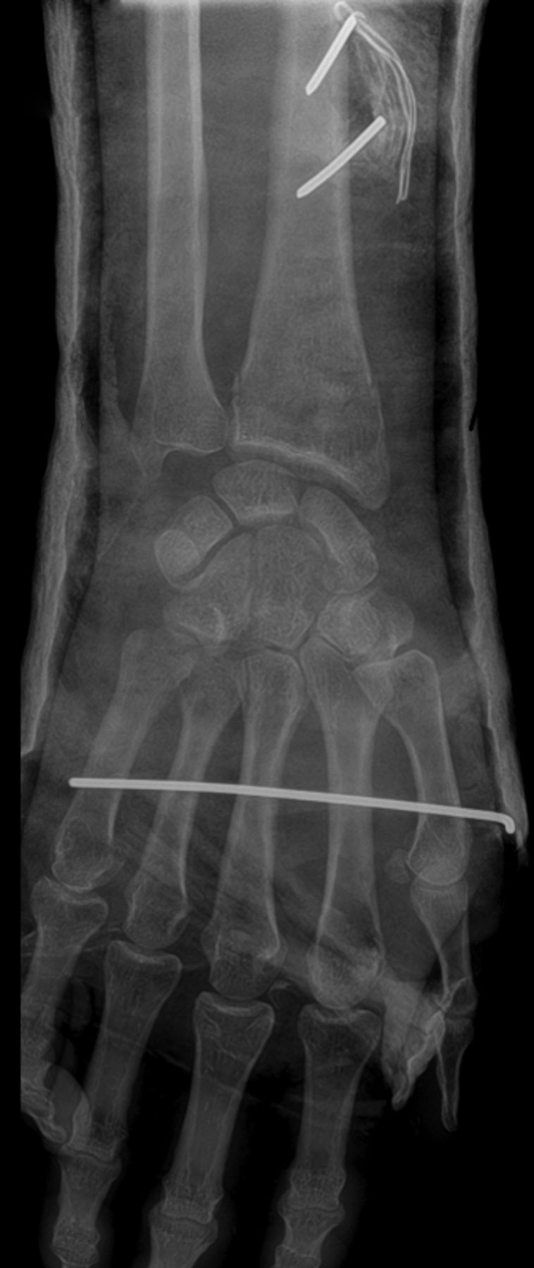 Figs. 1a - 1b 
            Radiographs showing a) an
anteroposterior view with two pins inserted proximal to the fracture
site, providing a buttress to maintain alignment. Another pin is
inserted in the second and third metacarpal bone, with the pin bent
at the radial side. The b) lateral view shows pins which engaged
both cortices of the bone, and remained out of the skin
          