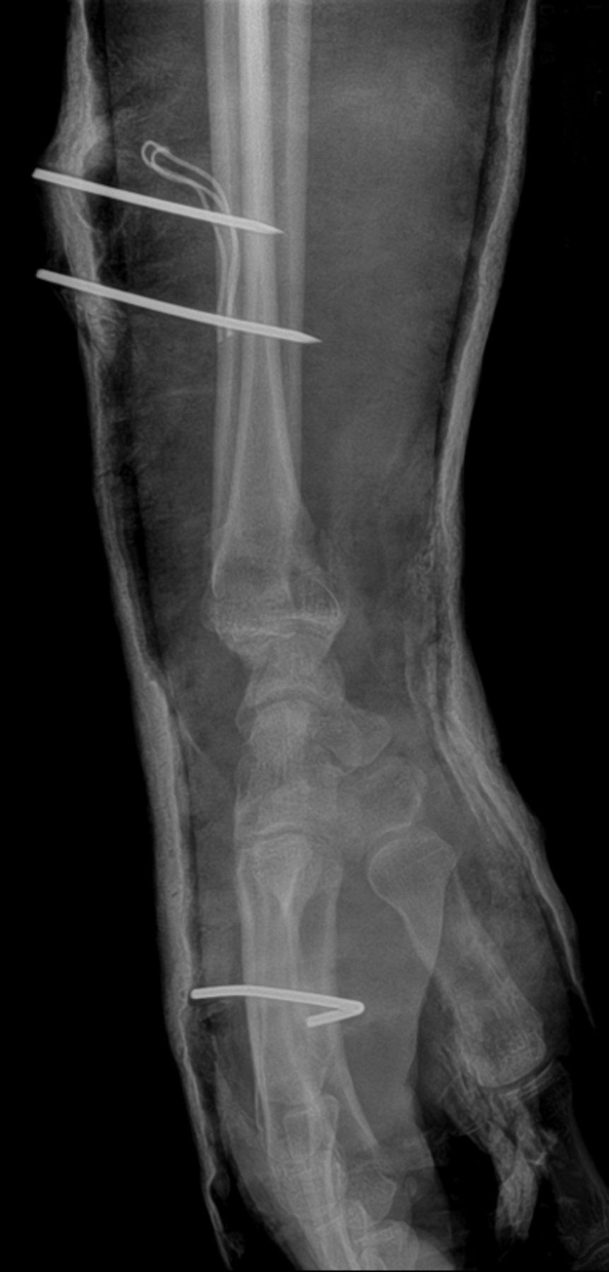 Figs. 1a - 1b 
            Radiographs showing a) an
anteroposterior view with two pins inserted proximal to the fracture
site, providing a buttress to maintain alignment. Another pin is
inserted in the second and third metacarpal bone, with the pin bent
at the radial side. The b) lateral view shows pins which engaged
both cortices of the bone, and remained out of the skin
          