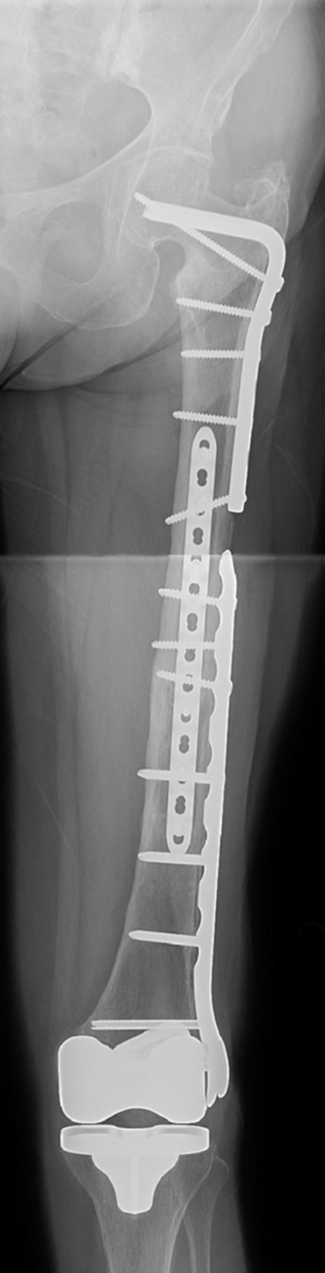 Fig. 1 
          Anteroposterior radiograph of
left femur showing orthogonal plate fixation of a patient with an
interprosthetic femoral fracture between a stable total knee arthroplasty
and proximal blade plate. The fracture was treated with a distal
lateral femoral locking plate, and anterior small fragment locking
plate to protect the lateral inter-plate distance. This image was
obtained at a six month post-operative visit and shows uneventful
union.
        