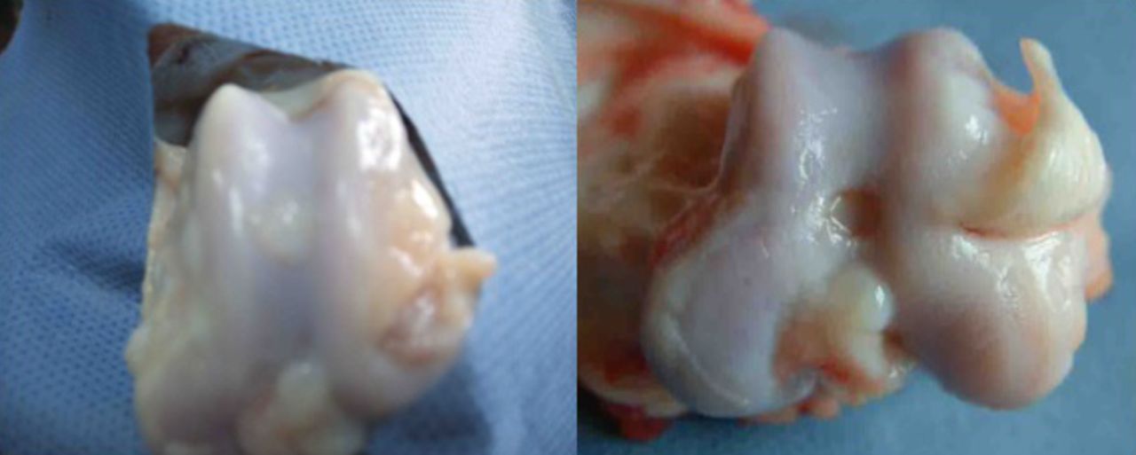 Fig. 7 
          Photographs of the surface of the cartilage
at 24 weeks post-operatively in the experimental group (control
group on the right). The regenerated tissues were smooth, and of
a colour and lustre similar to that of the surrounding normal cartilage.
        