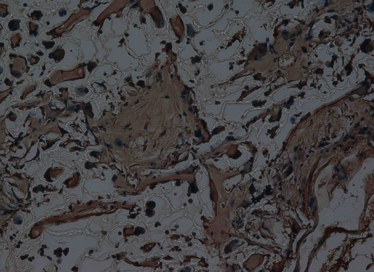 Fig. 9 
          Haematoxylin-eosin staining at 12 weeks
after surgery in the experimental group, observed using an optical microscope,
showing that the scaffold had partly degraded. Type II collagen
in chondrocyte plasma and extracellular matrix was stained a browny-yellow
colour (immunohistochemistry, × 200).
        