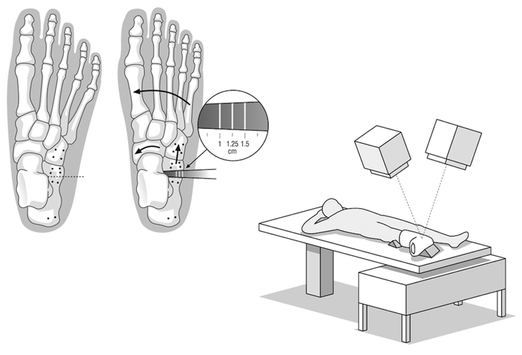 Fig. 1 
            Drawing showing the principles in a
lateral calcaneal lengthening osteotomy with inserted tantalum markers
(left) and the set-up of the radiostereometric analysis (right).
          