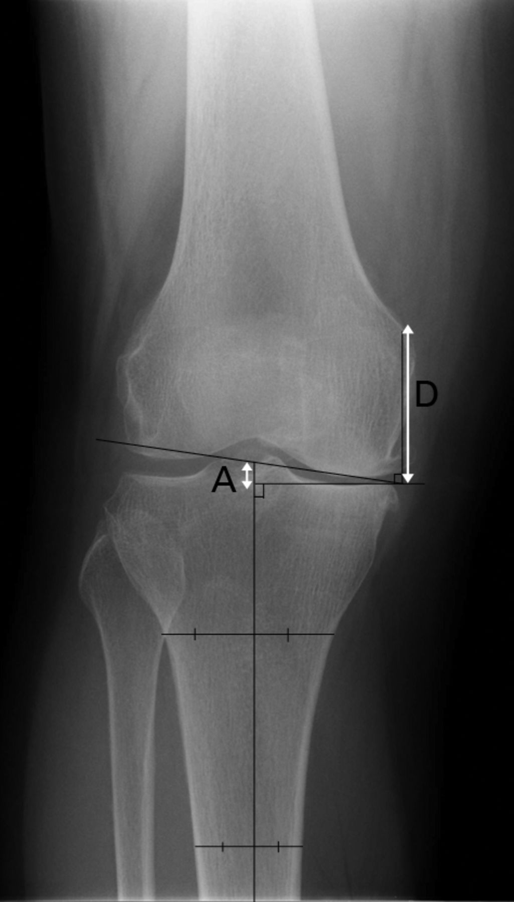 Figs. 1a - 1b 
            Pre-operative anteroposterior
radiographs showing a) the distance between the adductor tubercle
as the distal point on the medial condylar slope of the femur and
the joint line (line D) and b) the depth of resection was defined
as differences between distance A and distance B. Line C was the
thickness of the tibial insert used to correct magnification.
          